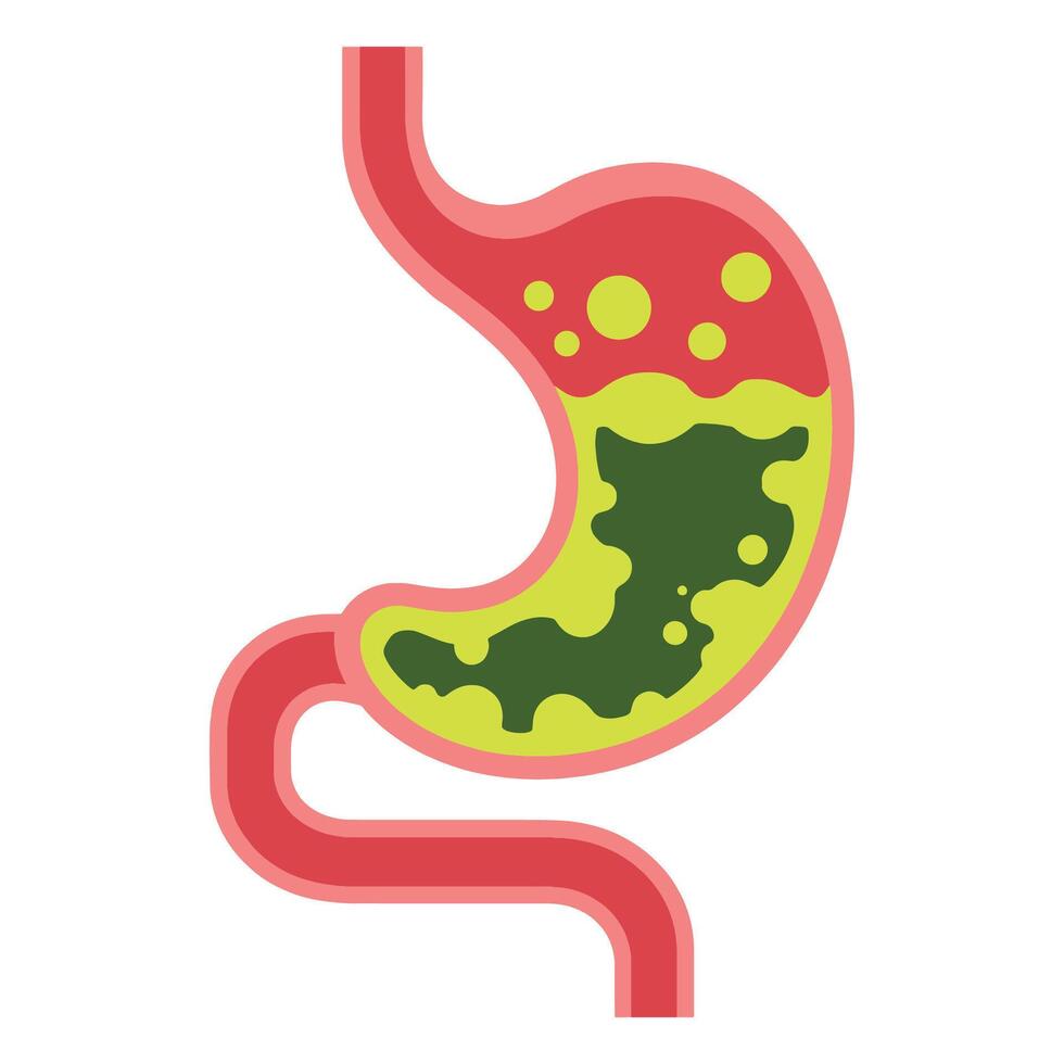 Human stomach illustration. Depicts gastritis, acid reflux, indigestion, heartburn, and stomach pain problems. Concept of illness, unhealthy stomach, and discomfort vector