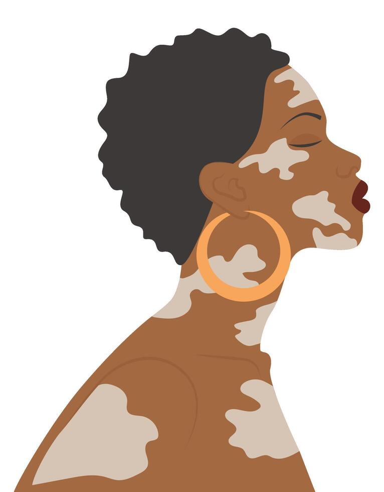 Afro American woman illustration with vitiligo. World Vitiligo Day. Selfcare concept. Simple cartoon style vector