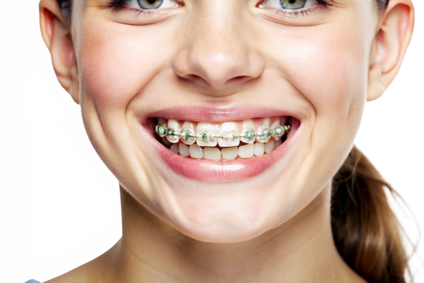 Closeup of a Young Woman Smiling and Showing Her Teeth with Clear Braces and Green Accents png