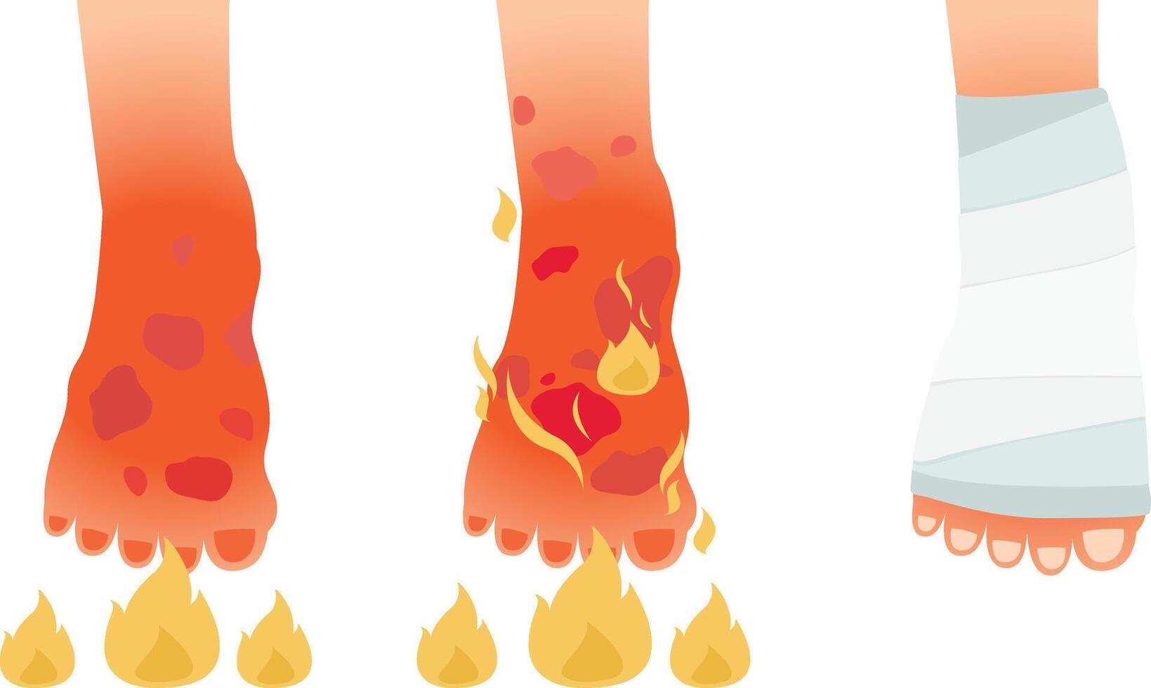 Burn of foot human skin illustration vector