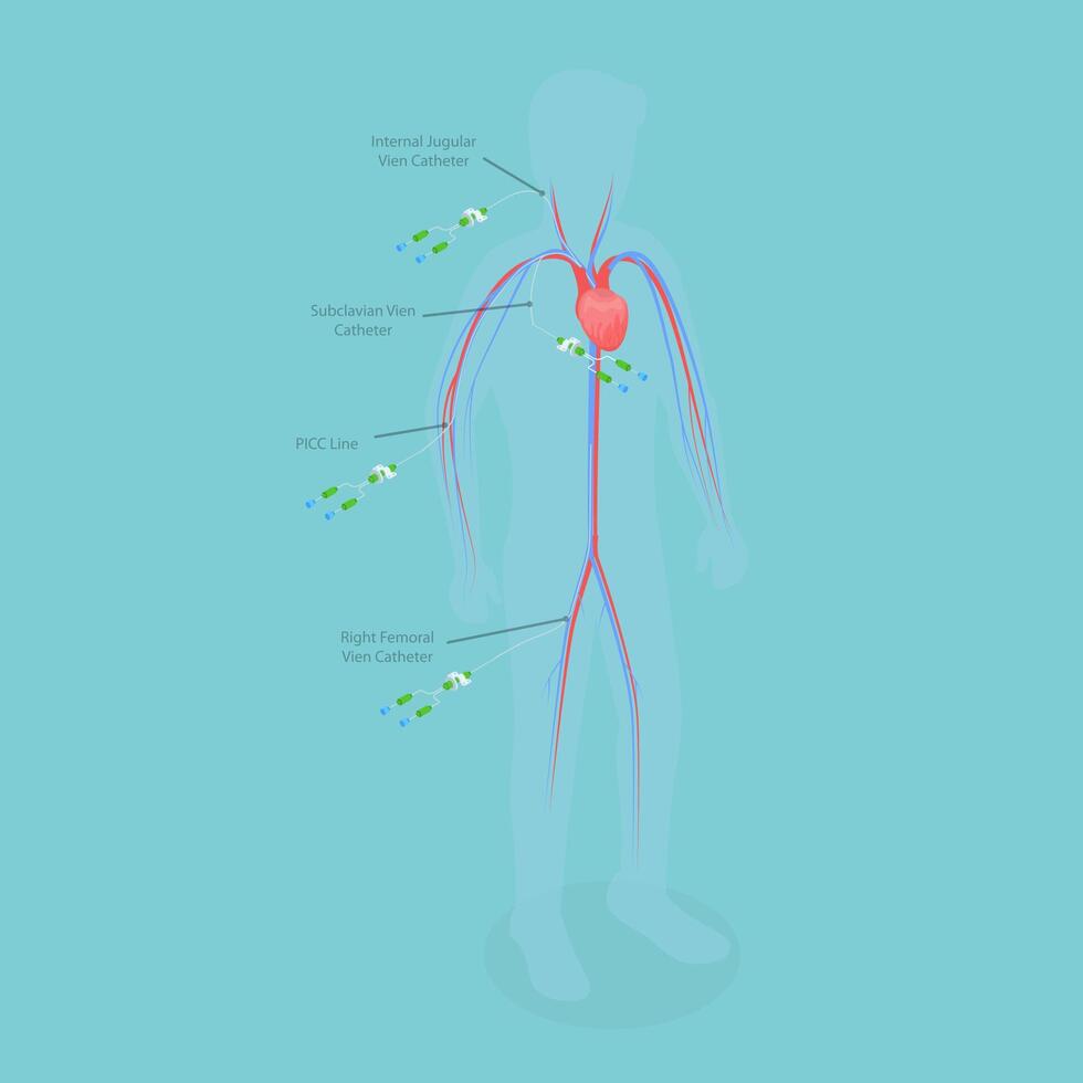 3D Isometric Flat Conceptual Illustration of PICC Line , Central Venous Catheter vector