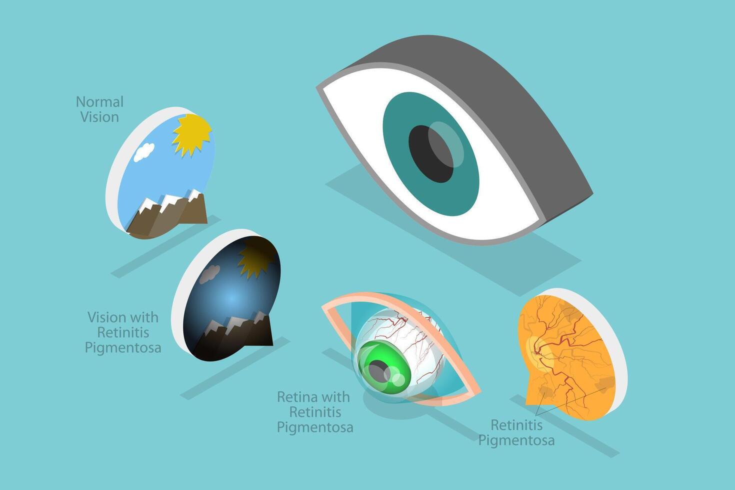 3D Isometric Flat Conceptual Illustration of Retinal Degenerative Vision , Age-Related Macular Degeneration vector