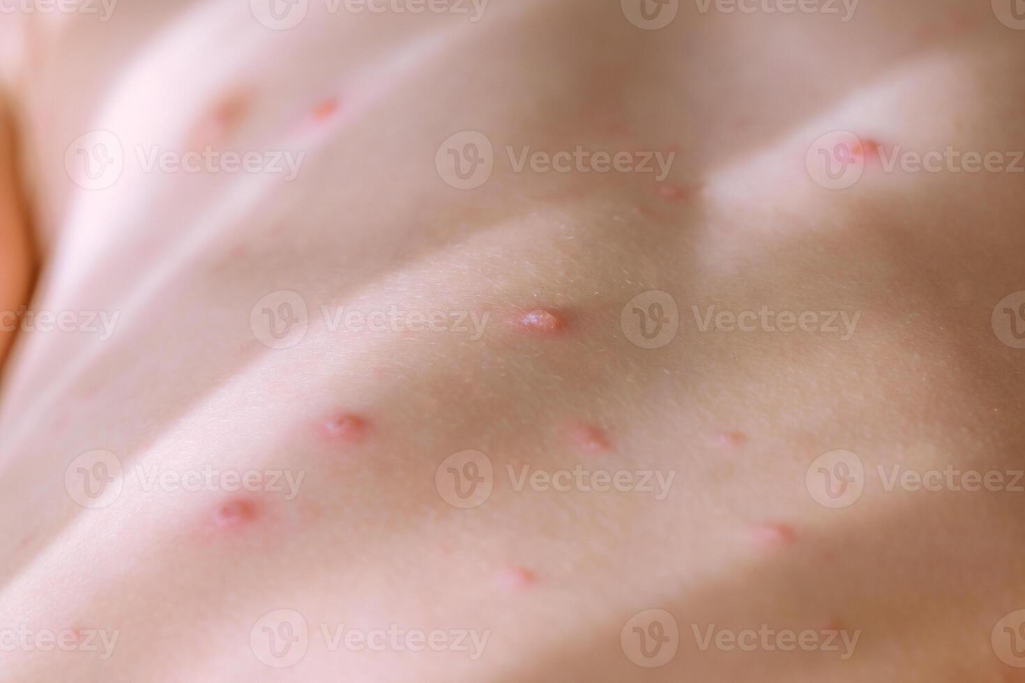 Chickenpox blisters on body of child photo