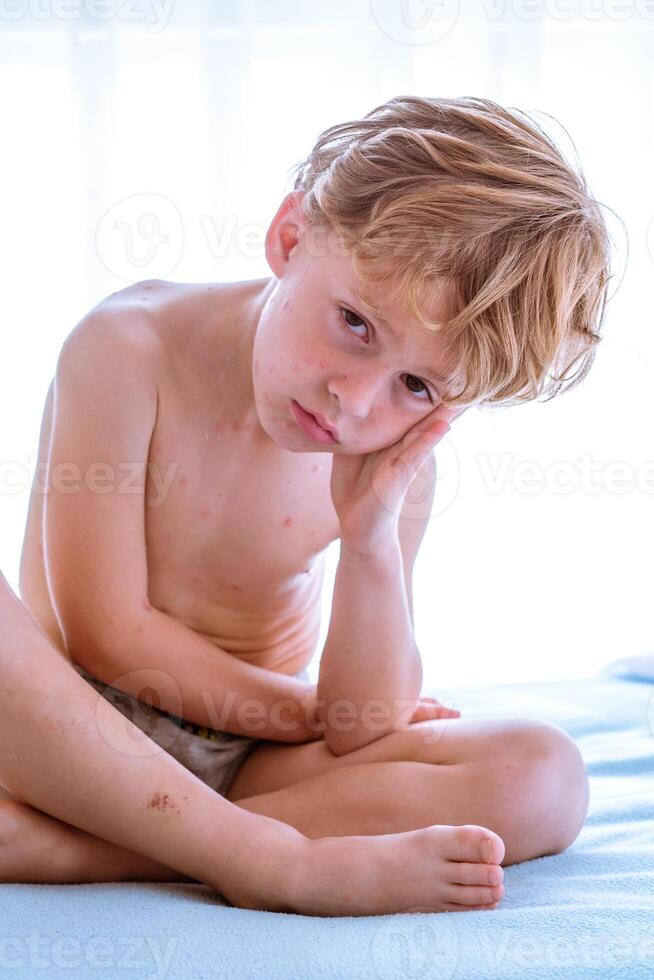 Boy with chickenpox sitting on bed photo