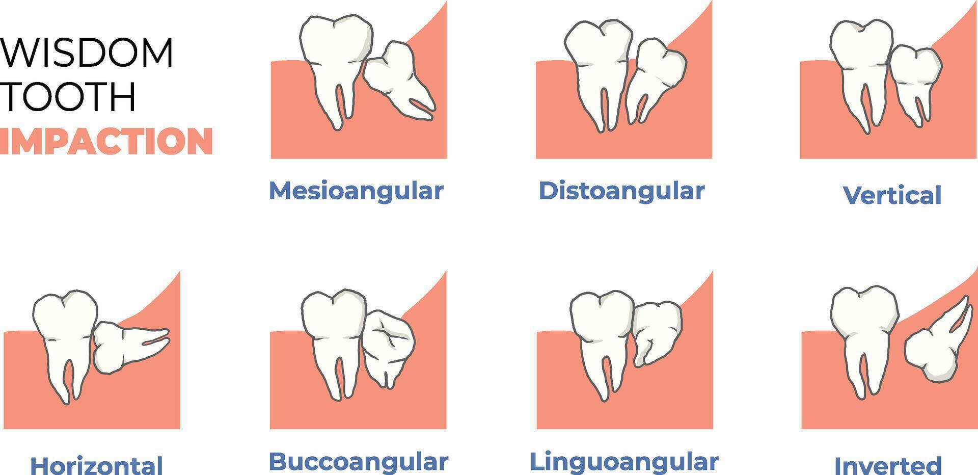 illustration of wisdom tooth impaction classifications vector