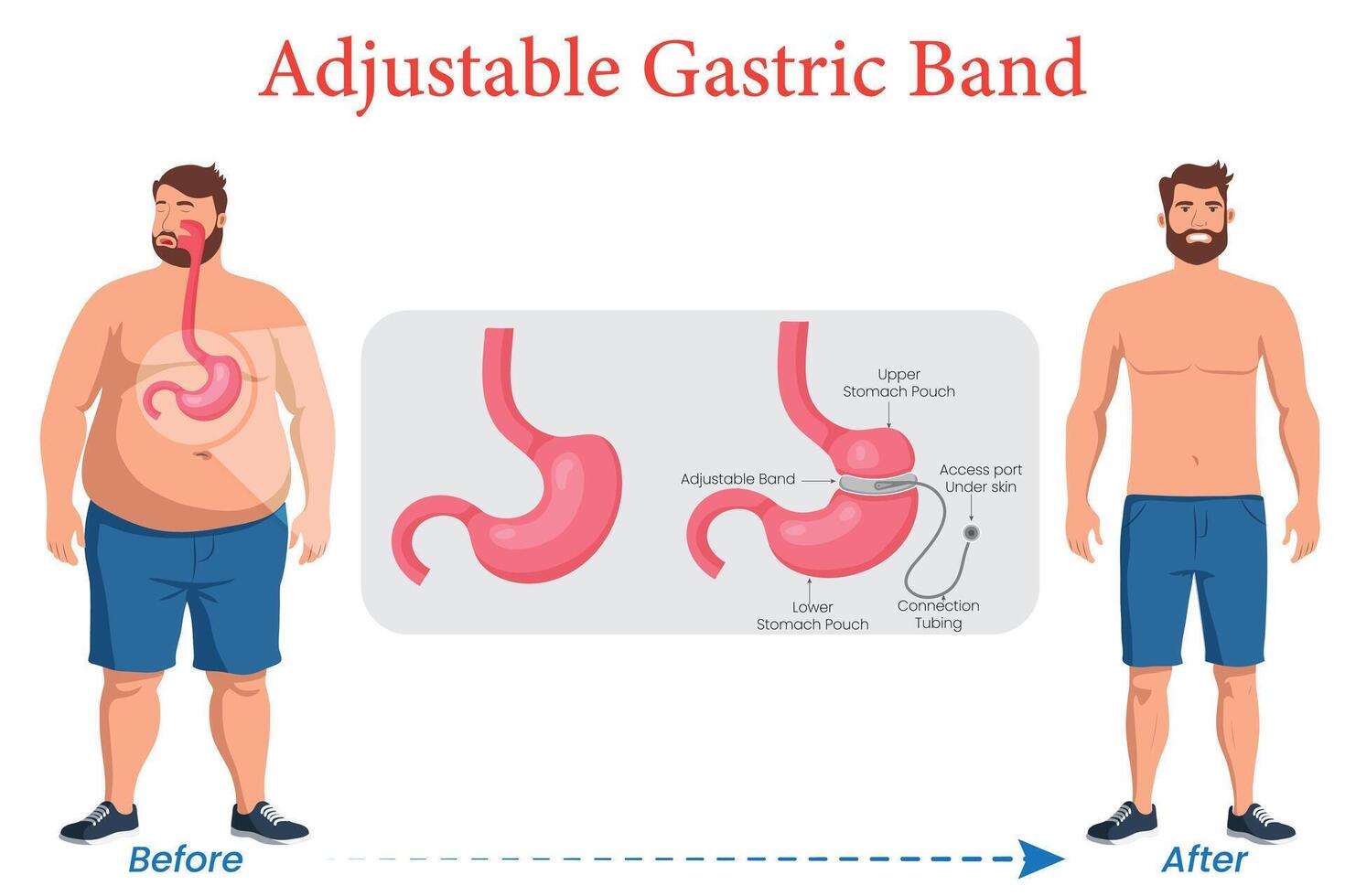Adjustable Gastric Band Before and After Transformation vector