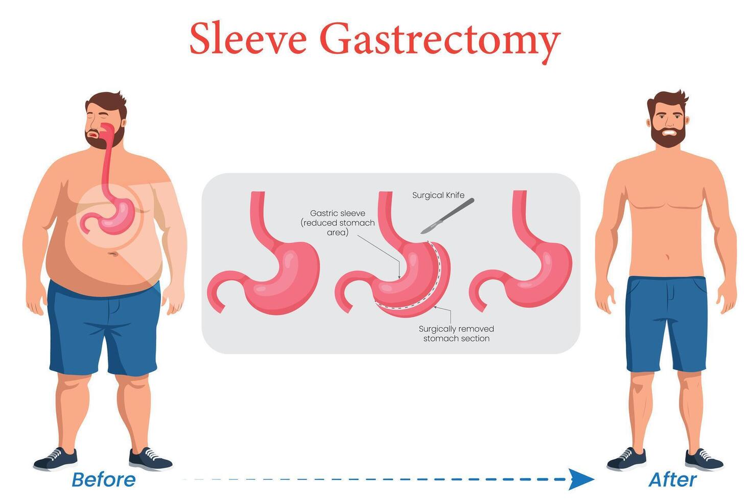 Sleeve Gastrectomy Before and After Transformation Illustrated vector