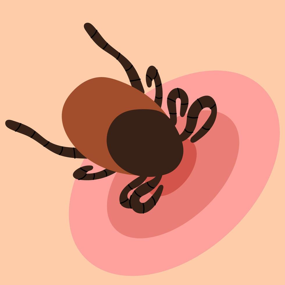 Encephalitis tick biting human skin causing lyme disease. Wild or domestic tick, skin parasites. House dust mite allergy.Healthcare illustration. vector