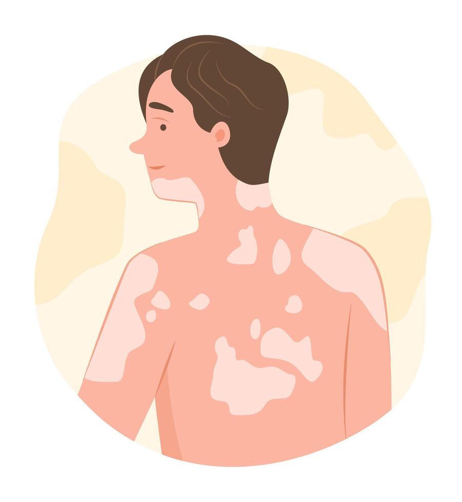 Young Man with Vitiligo Disease on Body Skin for Dermatological Symptom Concept Illustration Clip Art vector