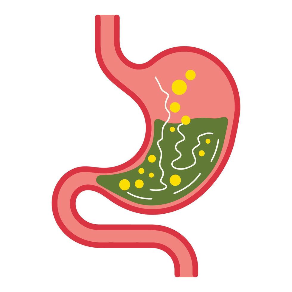 Human stomach illustration. Depicts gastritis, acid reflux, indigestion, heartburn, and stomach pain problems. Concept of illness, discomfort, unhealthy stomach. vector