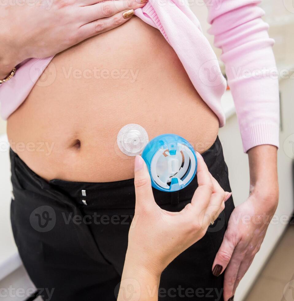 Doctor install patient insulin catheter for a simple injection of insulin. photo