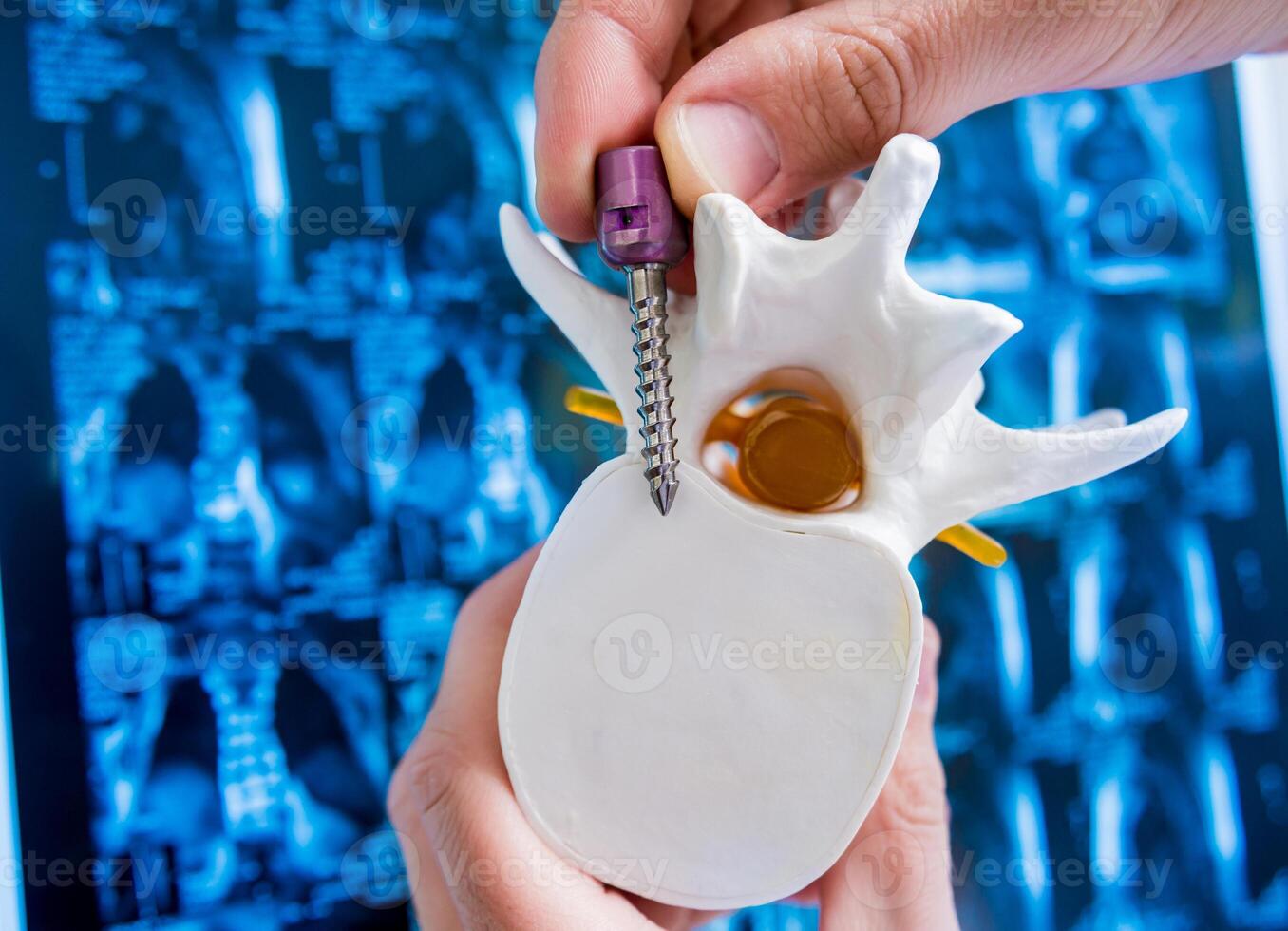 Doctor show polyaxial screw on the spine model. Spine fixation systems photo