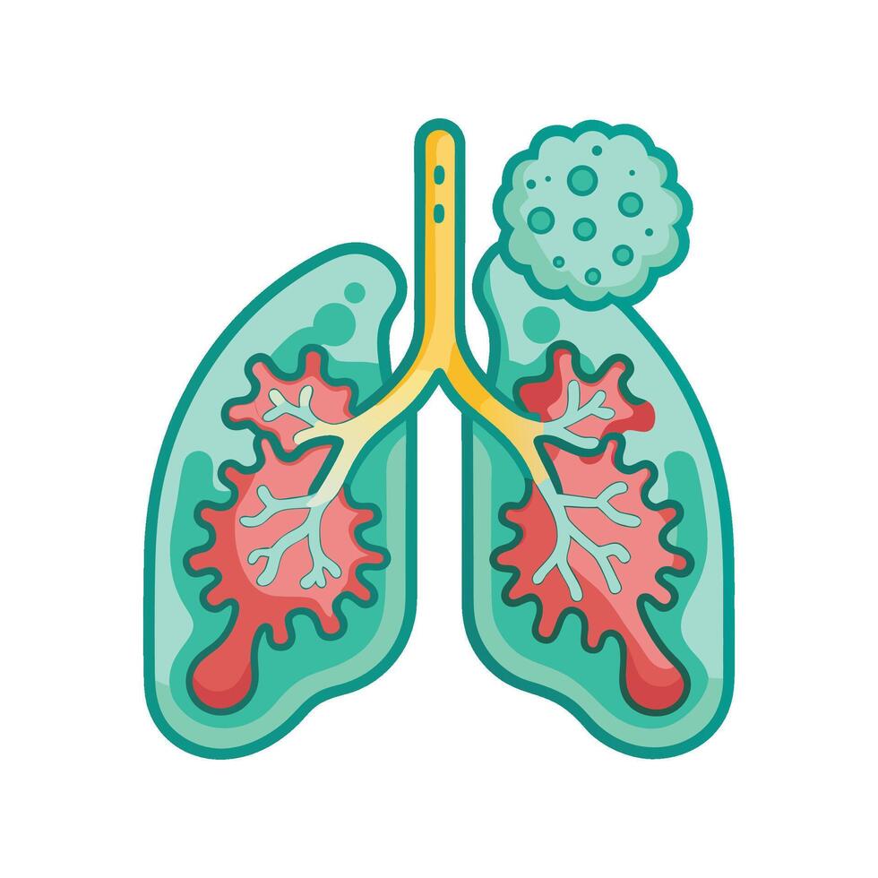 Pneumonia in Lungs Caused by Bacteria vector