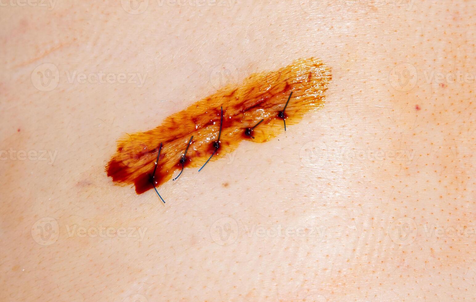 Treating the wound with iodine for healing. Surgical suture after surgery. Cosmetic stitches and threads on human skin. Plastic surgery photo