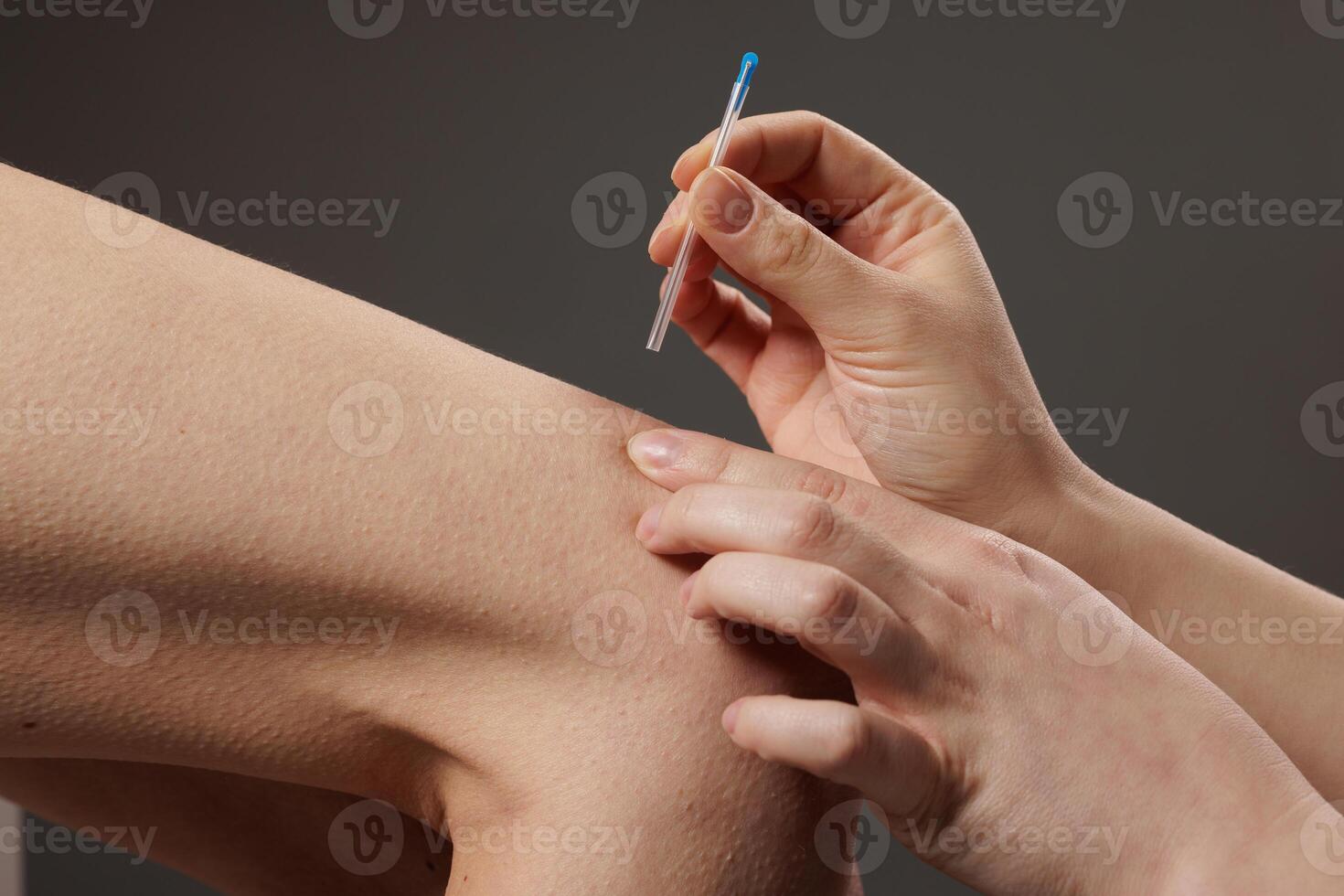 concept dry needling method. Acupuncture treatment close-up. Therapist inserting a thin needle into patient's skin for alternative therapy, pain relief, and wellness. photo