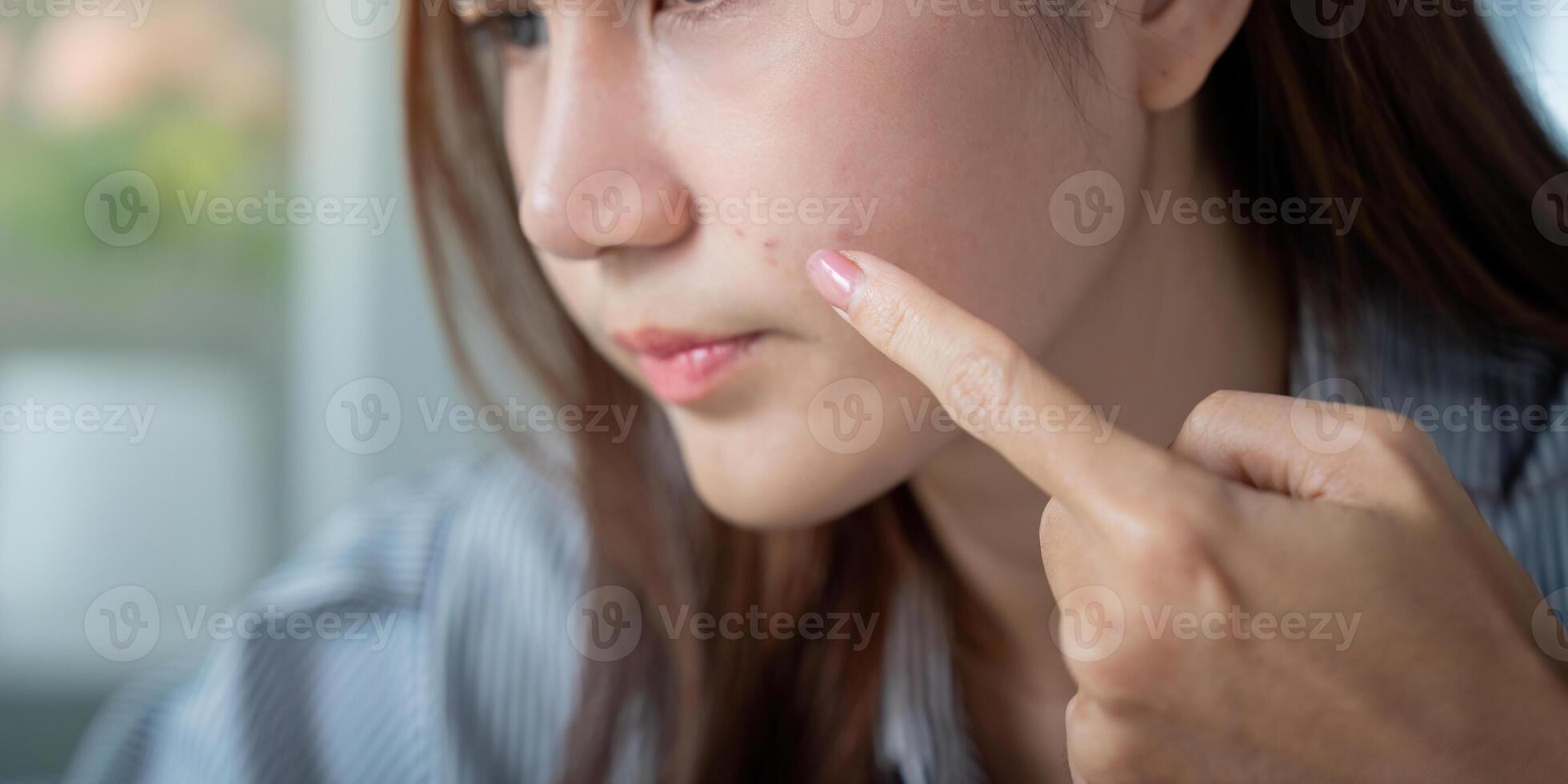 Skin Troubles and Acne Awareness. Woman pointing to a blemish with concern. photo