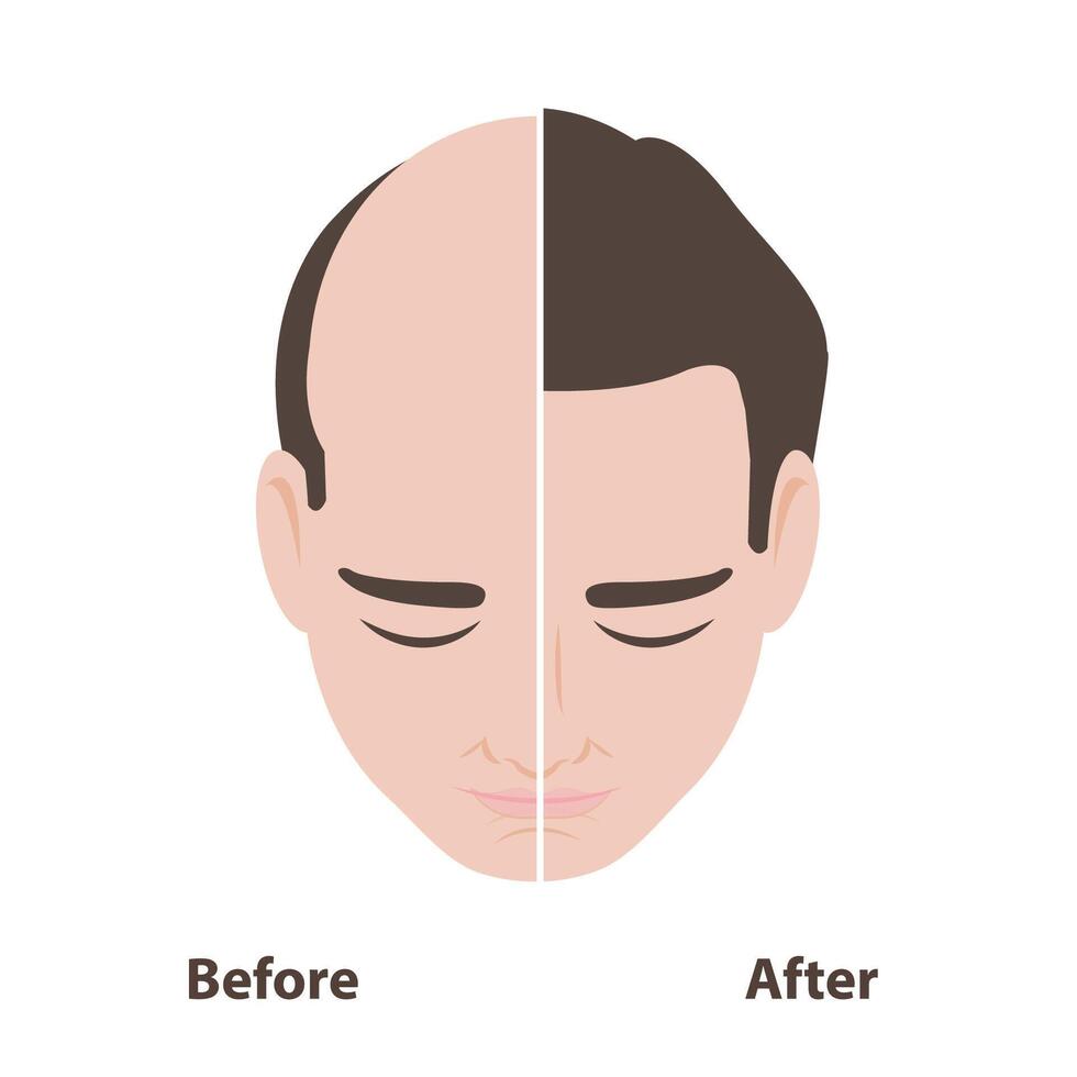 Before and after hair restoration treatment illustration isolated on white background. Comparison of the man with baldness and restore hair growth. Hair transplant surgery recovery. vector