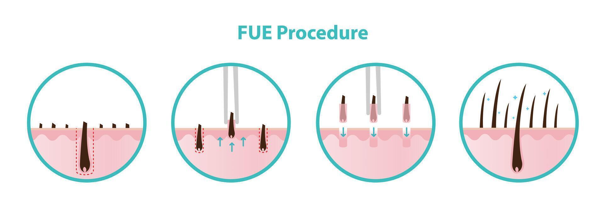 FUE hair transplant procedure icon set illustration isolated on white background. Extract hair grafts one by one from the donor area and transplanted into the target area. Hair care concept. vector