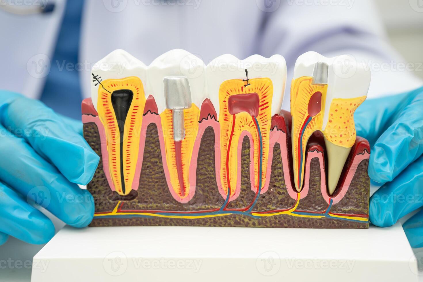 Asian dentist holding dental implant, artificial tooth roots into jaw, root canal of dental treatment, gum photo