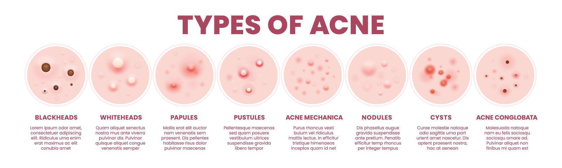 Body skin acne type pore inflammation infographics vector