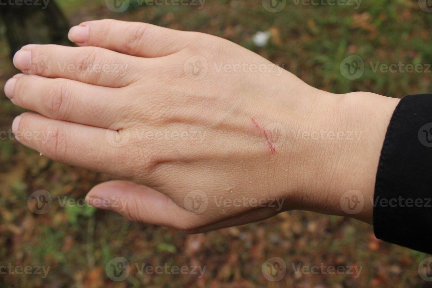 Close up scratch on hand of the back of a young woman's girl's hand photo