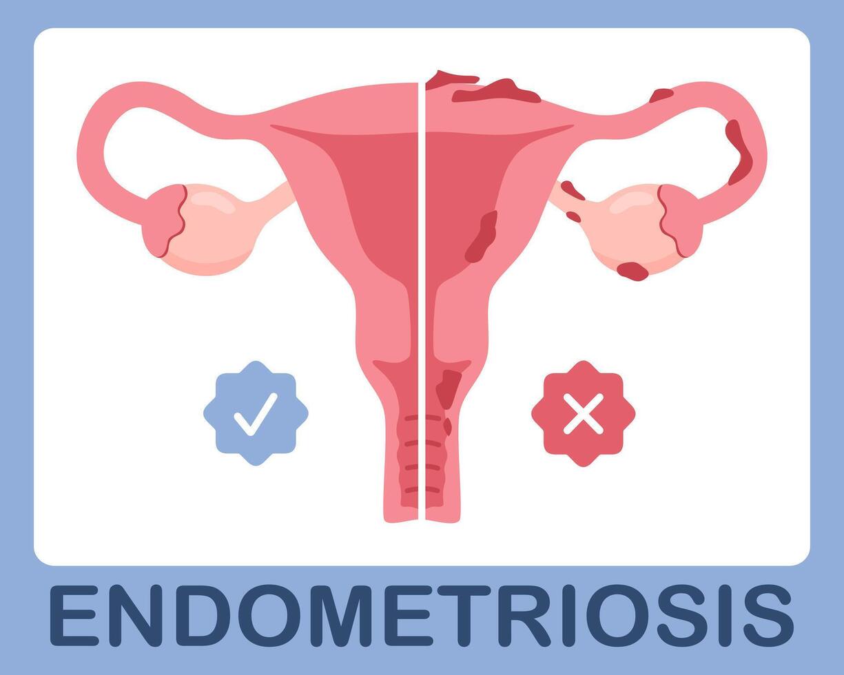 Uterus with endometriosis infographic, Comparison of a healthy uterus and a uterus with endometriosis vector
