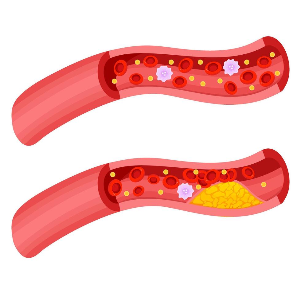 Blood vessel and blood clot illustration vector