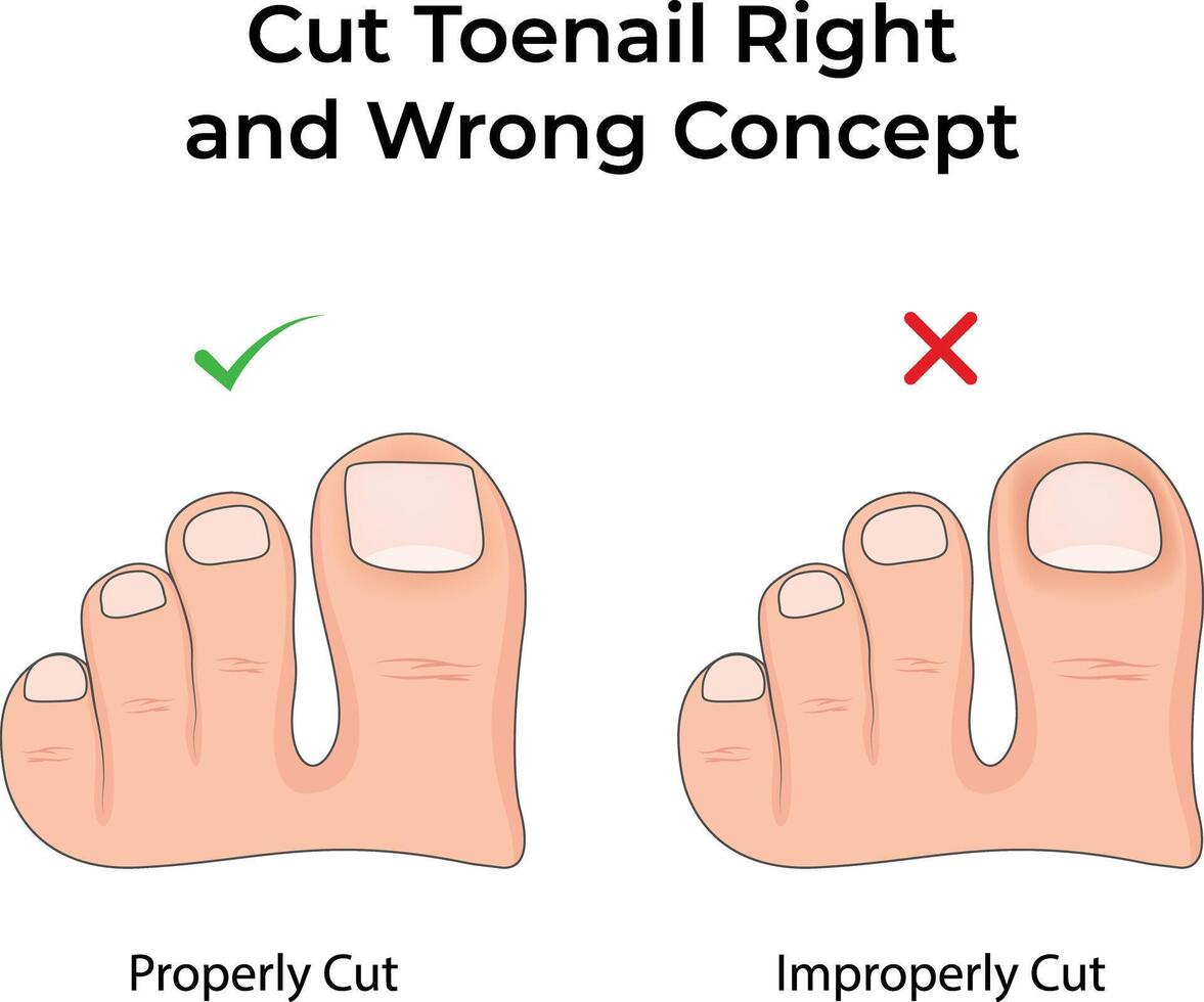 Proper vs Improper Toenail Cutting A Guide to Healthy Feet Illustration vector