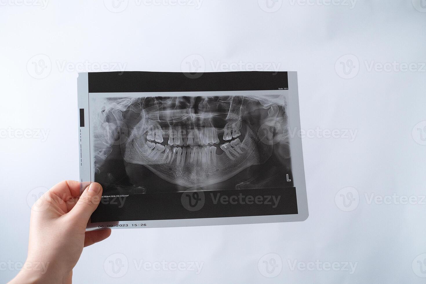 Dental X-ray diagnostics help identify hidden tooth problems and ensure accurate treatment planning. photo