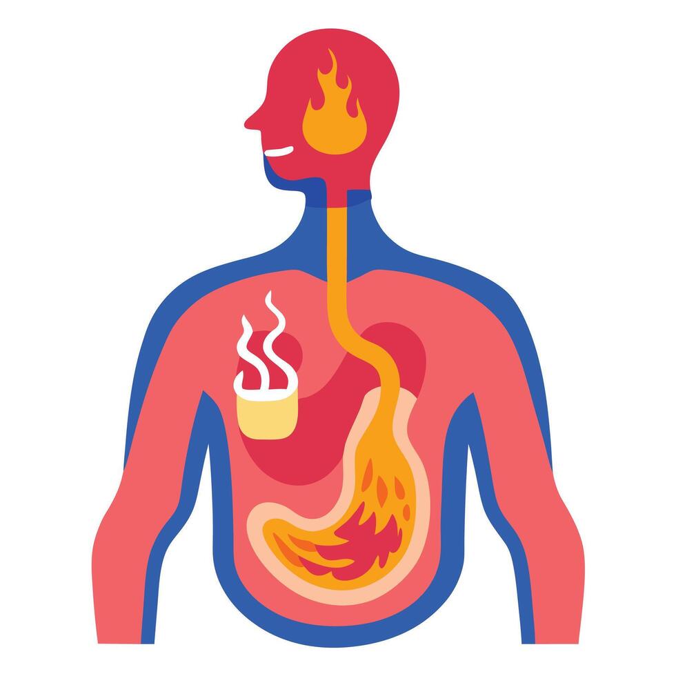 Acid Reflux with Torso, Esophagus, Stomach, Head, and Fire on White vector
