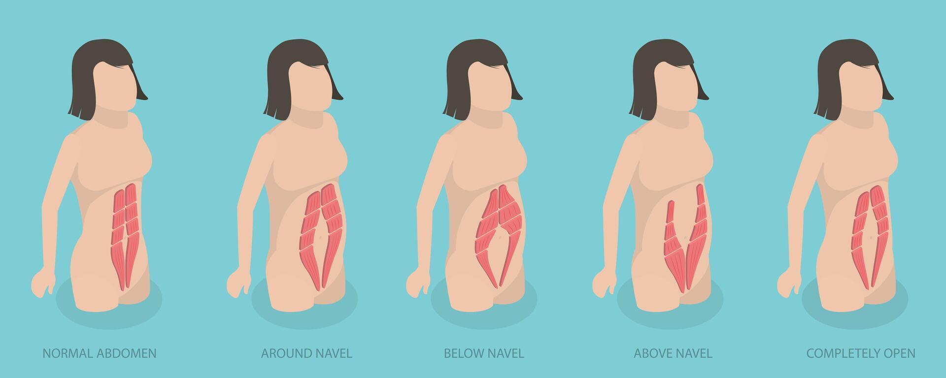 3D Isometric Flat Conceptual Illustration of Abdominal Muscle Diastasis, Women Probmlem After Pregnancy vector