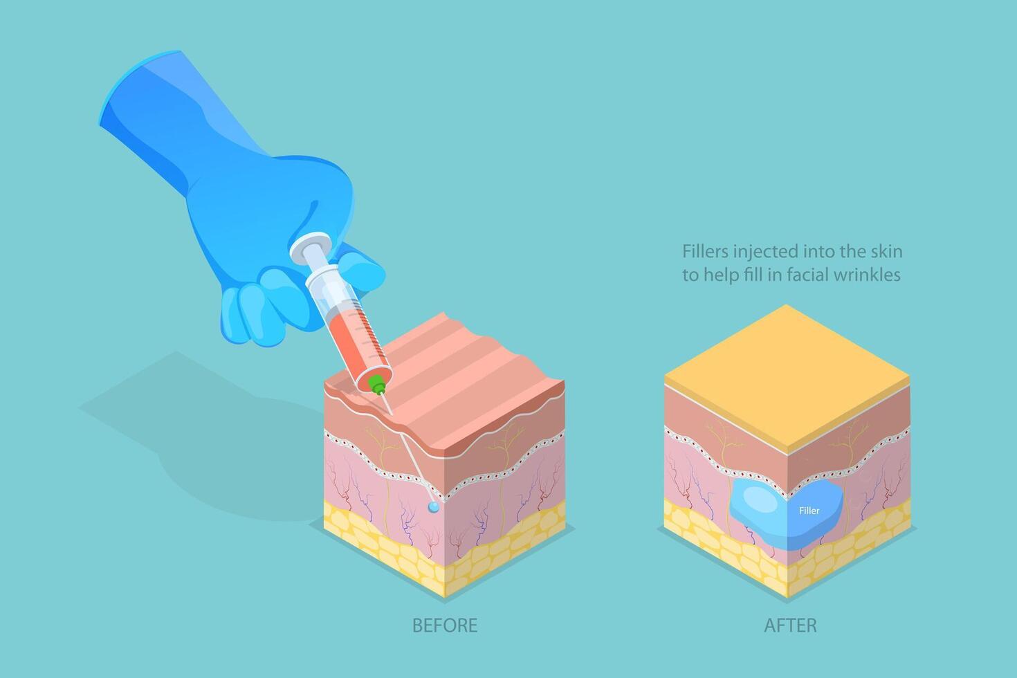 3D Isometric Flat Conceptual Illustration of Injectable Cosmetic Filler, Anti-wrinkle Injection vector