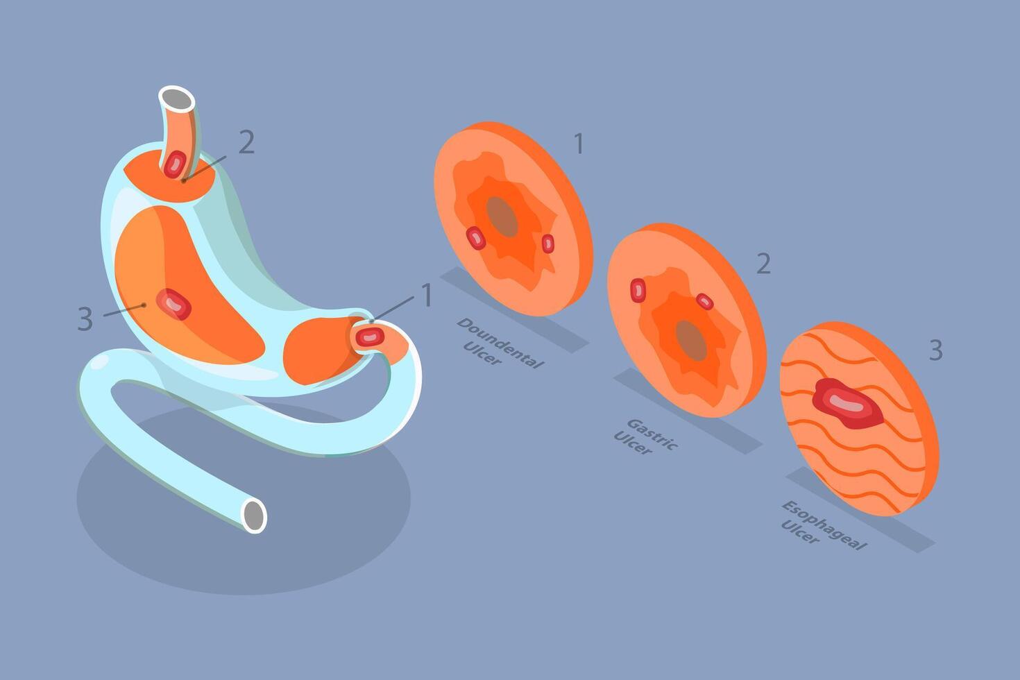 3D Isometric Flat Conceptual Illustration of Peptic Ulcer Stomach Disease, Gastritis and Inflammation vector
