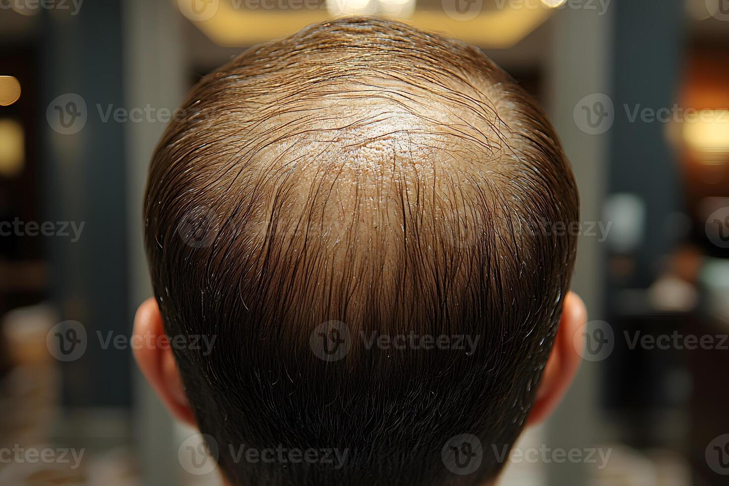 Baldness and Hair Loss Concept for Medical and Cosmetic Use in Stock Photography photo