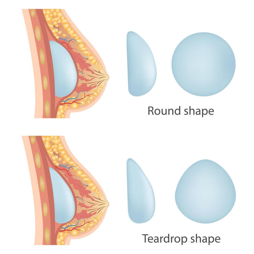 Breast augmentation with implant or breast surgery, injection of silicone gel using prepectoral vector
