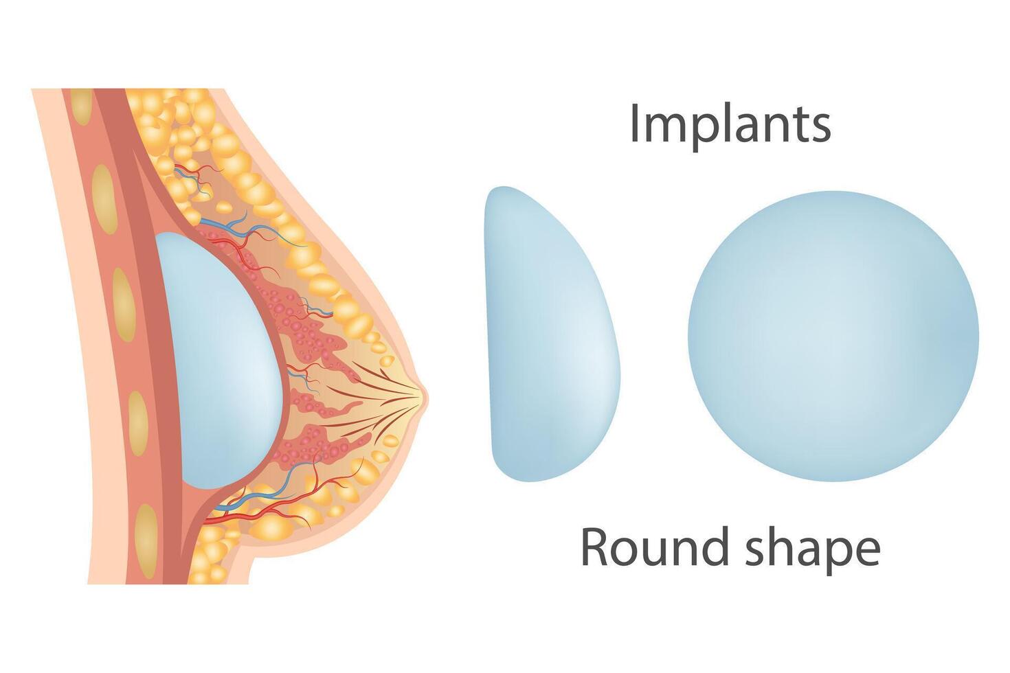 Silicone for breast surgery. Submuscular placement types. Plastic surgery of breast implants vector