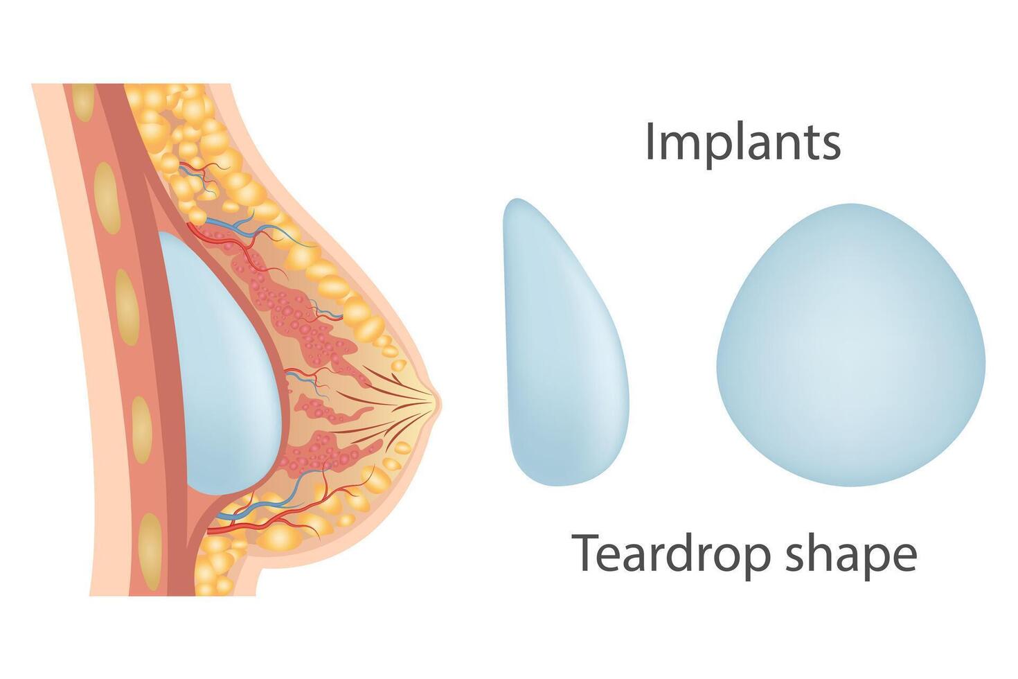 Breast augmentation with implant or breast surgery, injection of silicone gel using prepectoral and subpectoral technique, vector