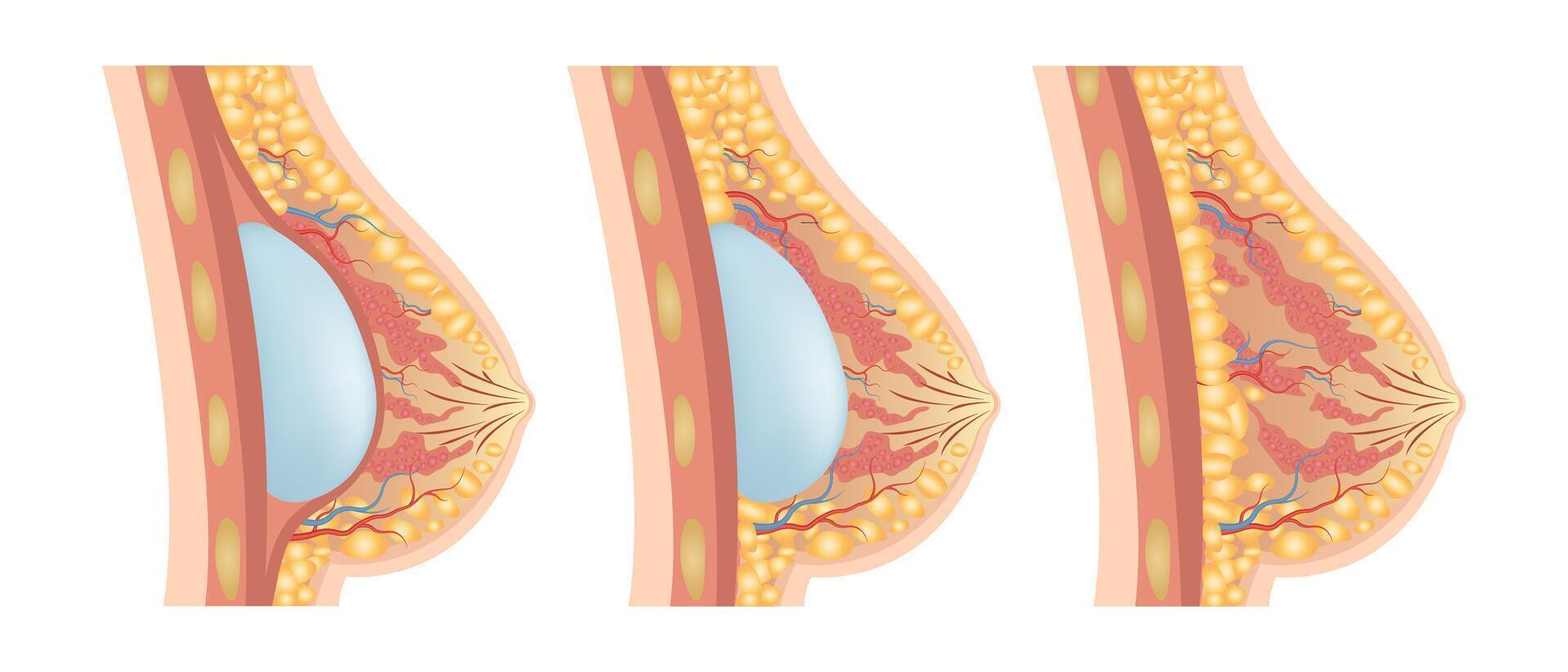 Breast augmentation with implant or breast surgery, injection of silicone gel vector