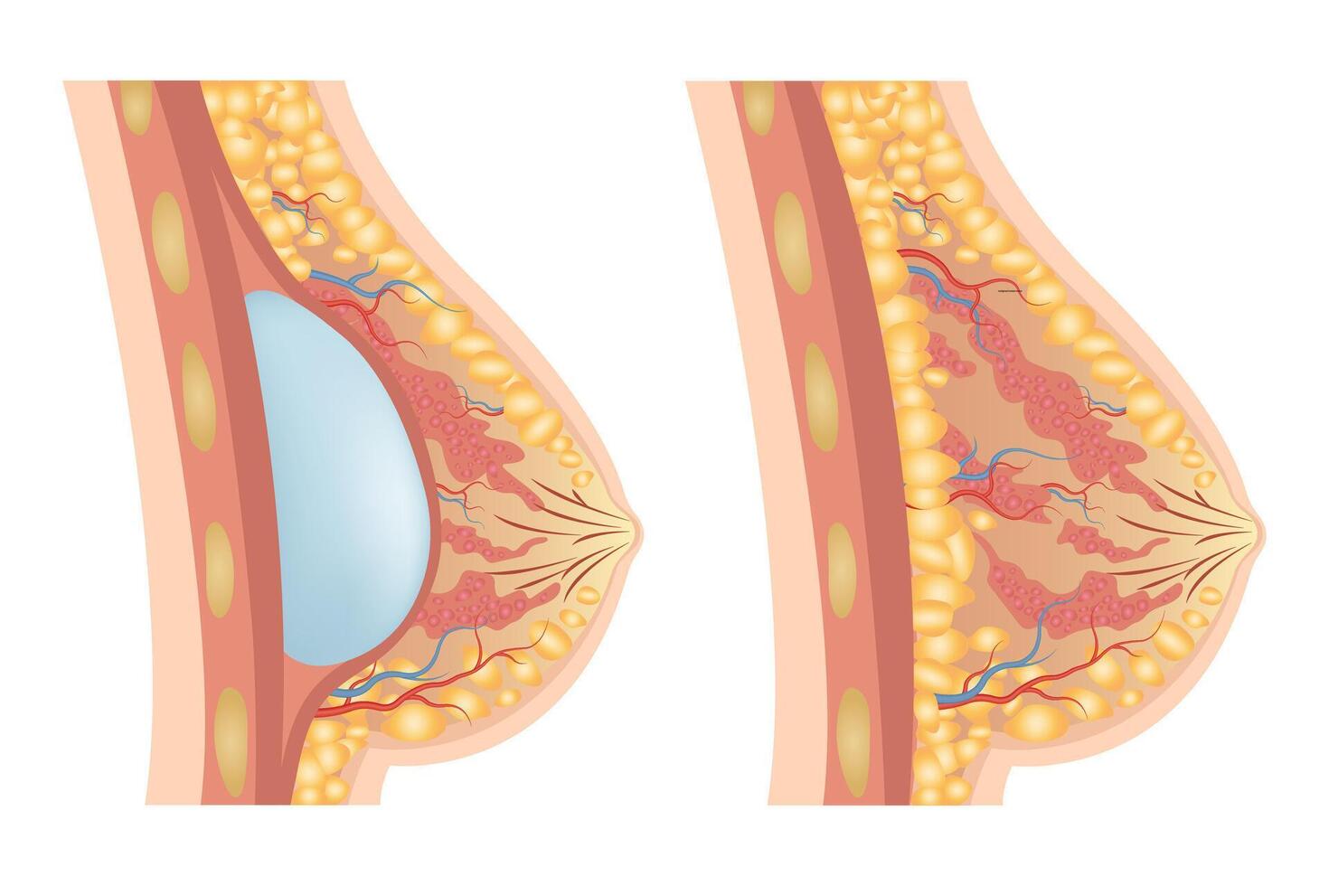 Breast augmentation with implant or breast surgery, injection of silicone gel using vector