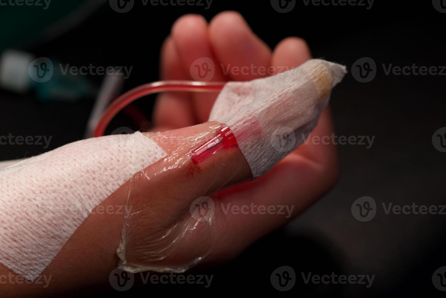 Close up of hand with medical intravenous line inserted, secured with tape, and connected to red tube photo