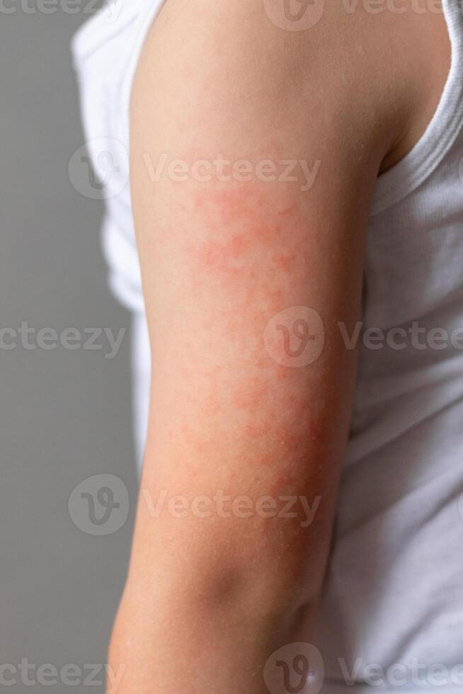 Child's arm with red rash photo