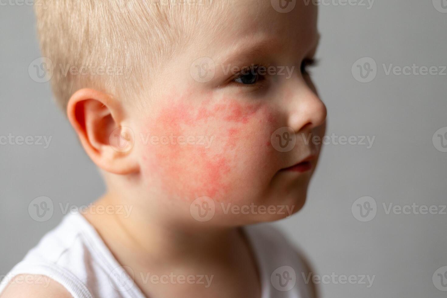 Small child with red rash on cheek photo