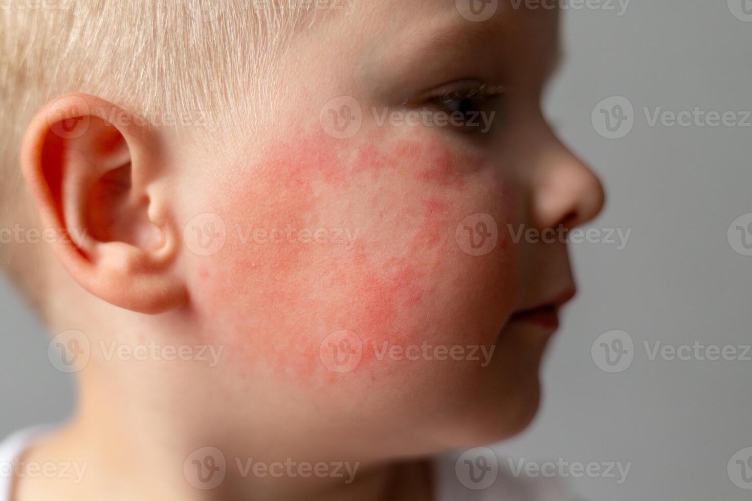 Small child with red rash on cheek photo