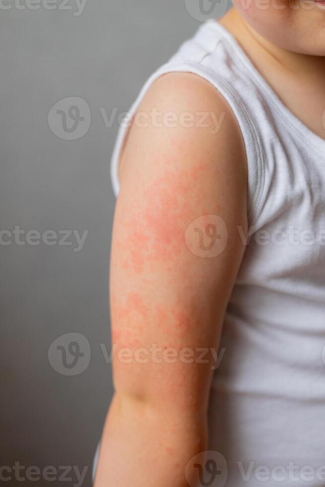Child's arm with red rash photo