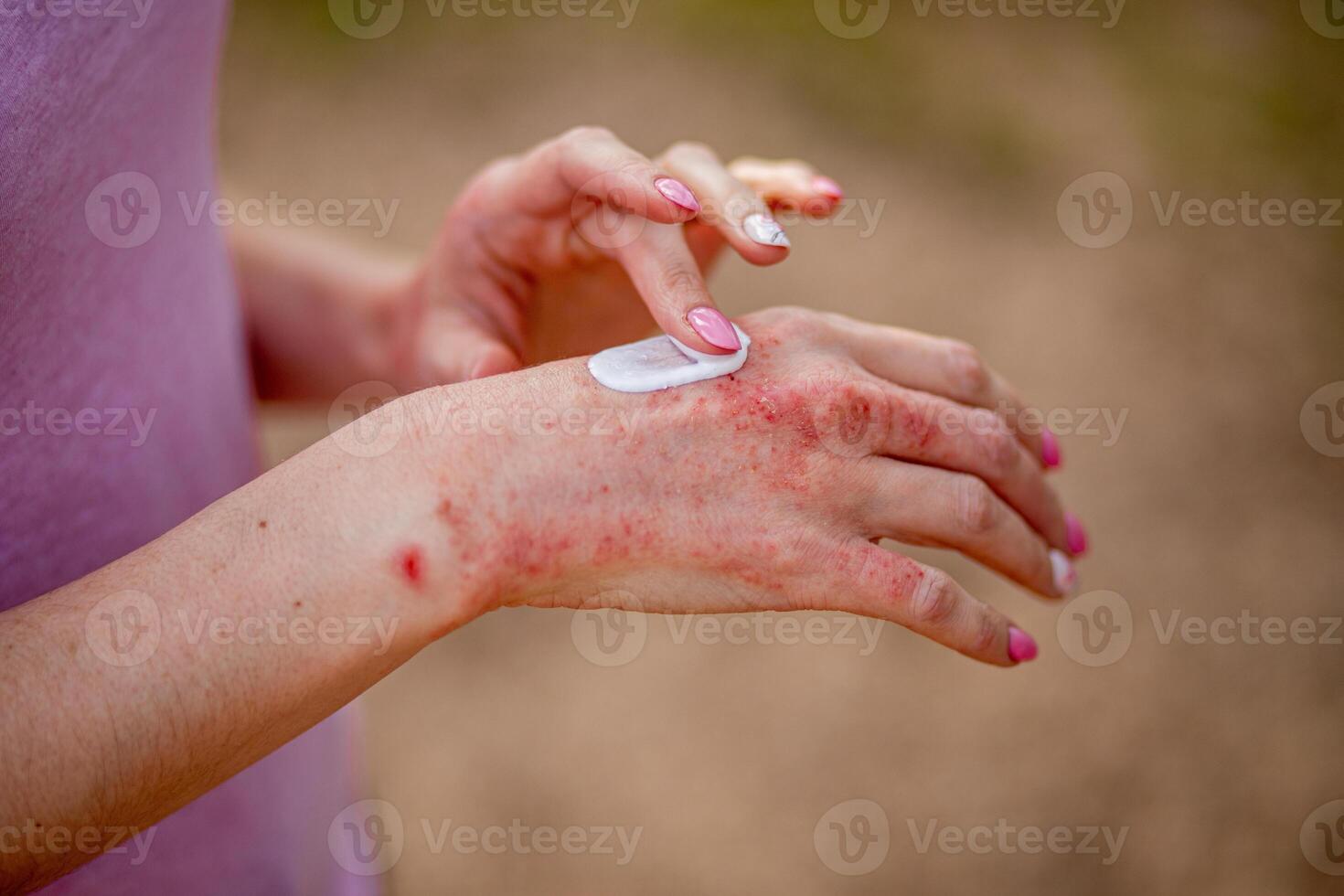 Eczema on the hands. The woman applying the ointment , creams in the treatment of eczema, psoriasis and other skin diseases. Skin problem concept photo