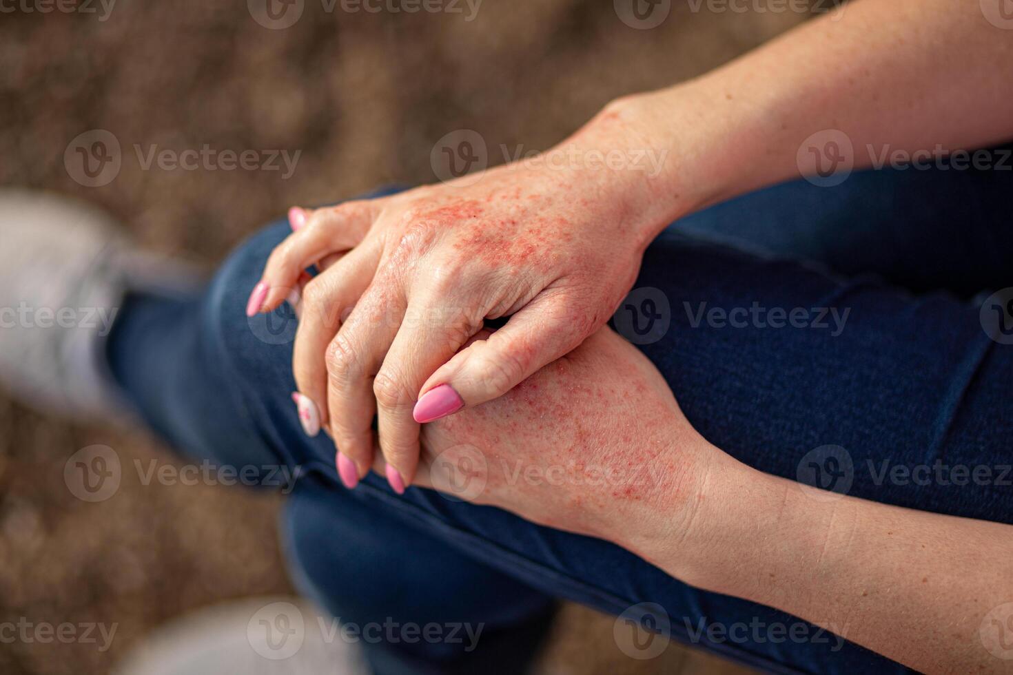 Close up dermatitis on skin, ill allergic rash eczema skin of patient , atopic dermatitis symptom skin detail texture , Fungus of skin ,The concept dermatology, treatment fungal photo