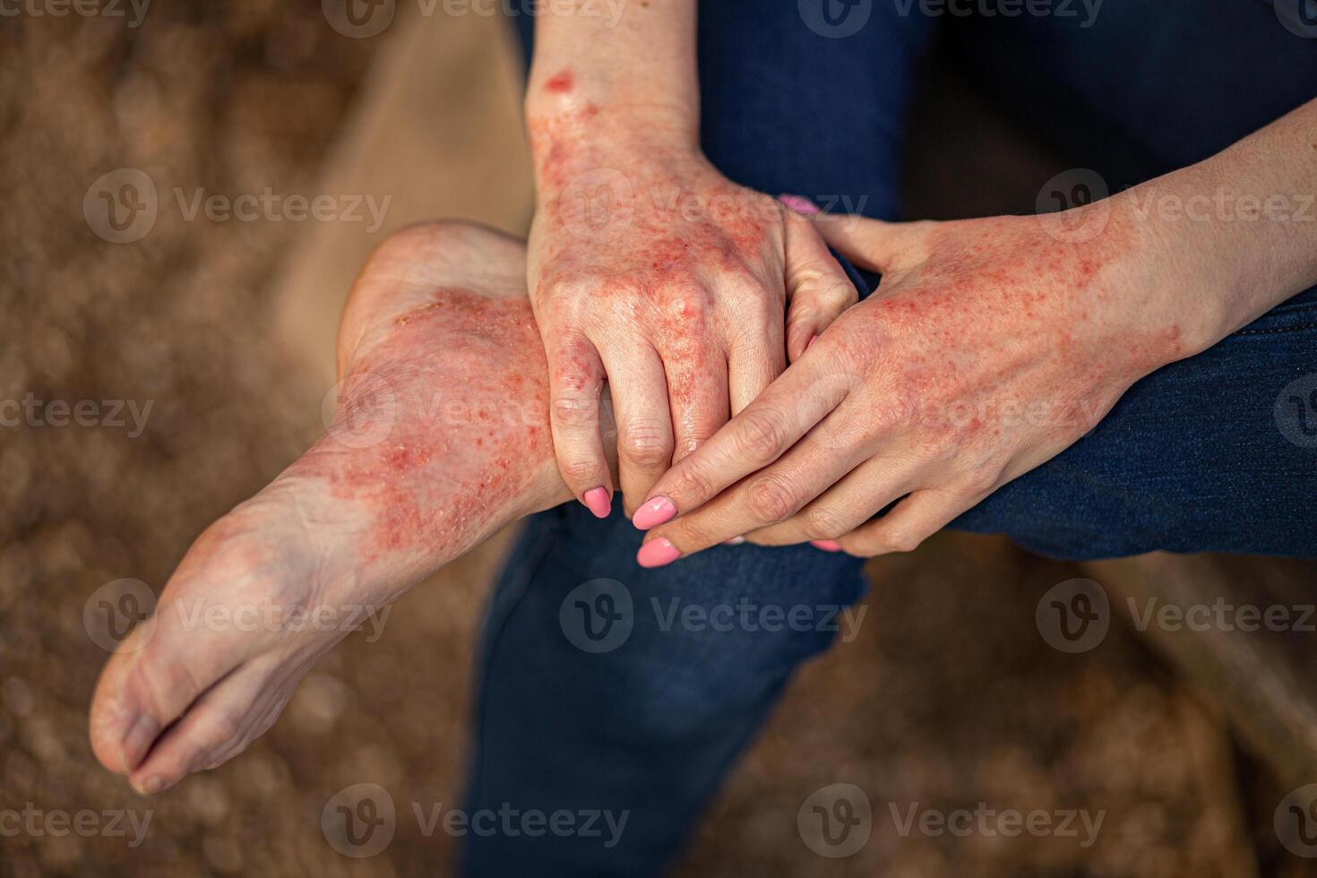 eczema dermatitis on hands and feet. red spots on the skin. dry skin photo