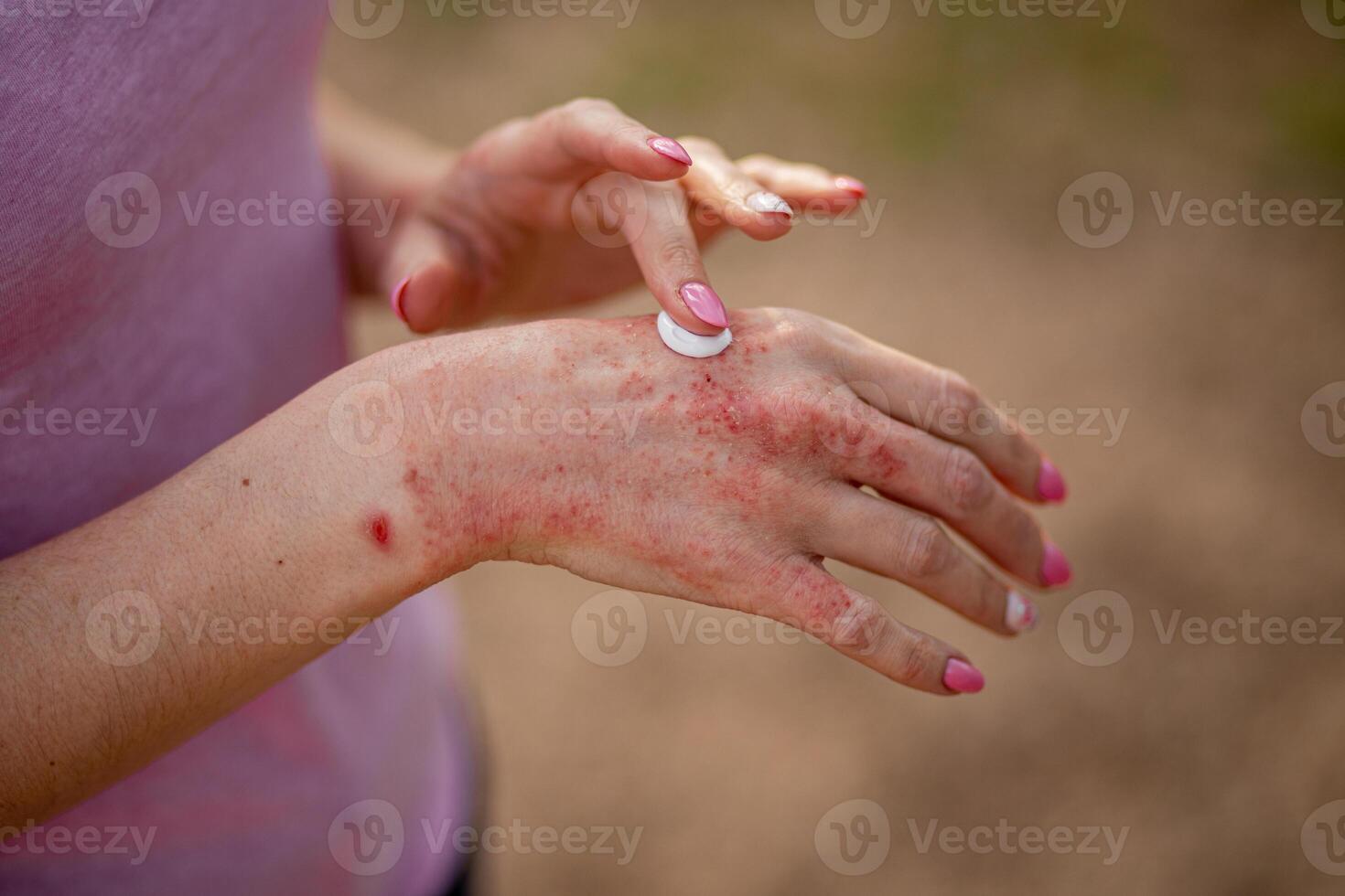 Eczema on the hands. The woman applying the ointment , creams in the treatment of eczema, psoriasis and other skin diseases. Skin problem concept photo