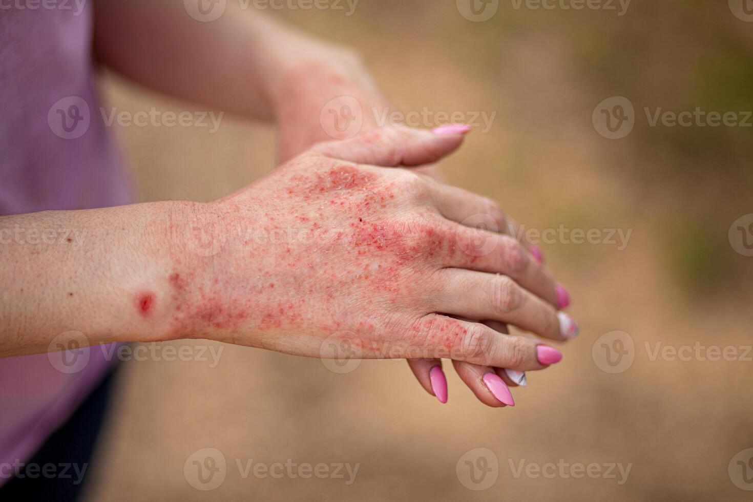 Close up dermatitis on skin, ill allergic rash eczema skin of patient , atopic dermatitis symptom skin detail texture , Fungus of skin ,The concept dermatology, treatment fungal photo
