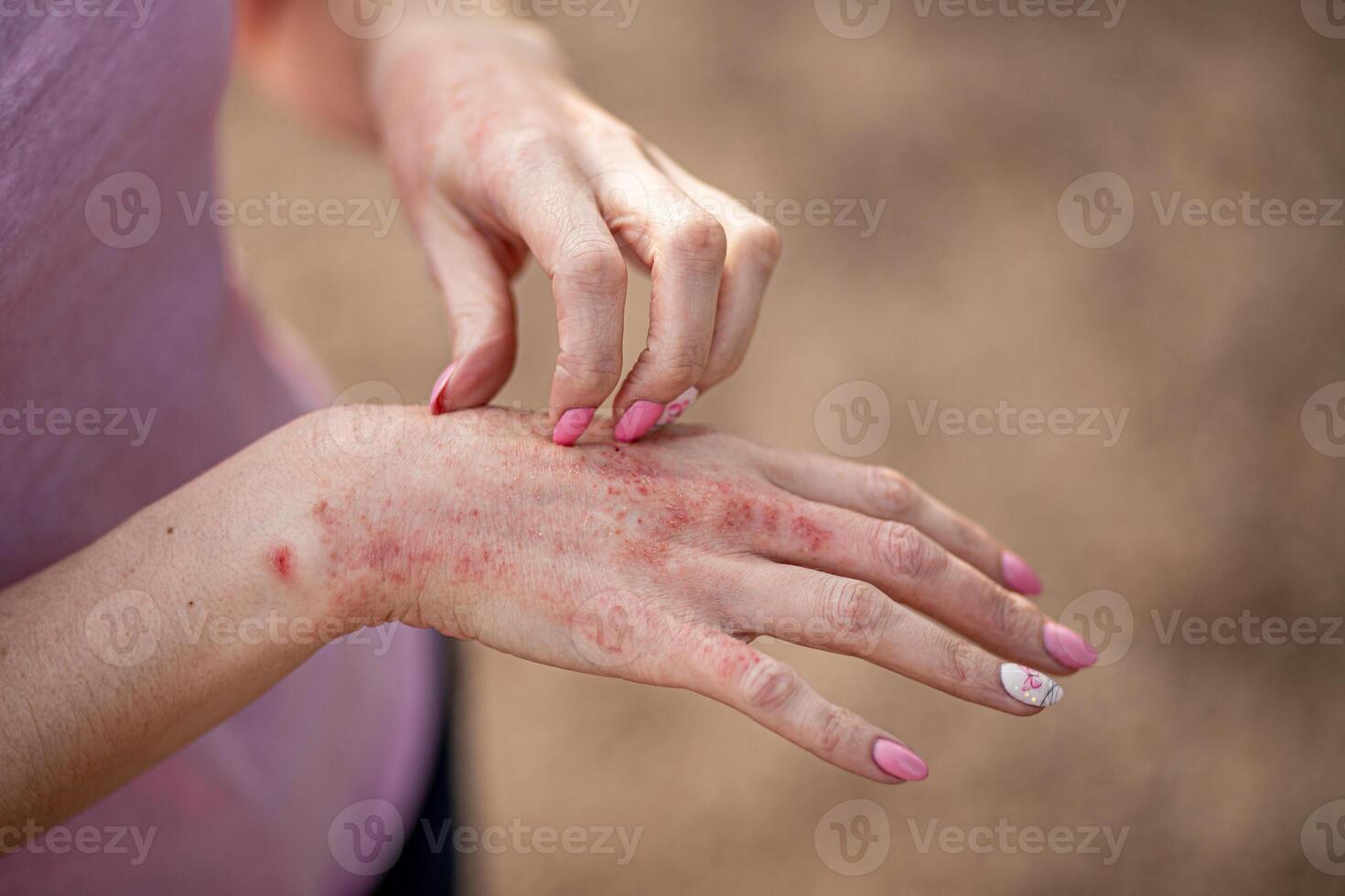 eczema dermatitis on hands and feet. red spots on the skin. dry skinThe concept dermatology, treatment fungal. woman scratching her hand photo